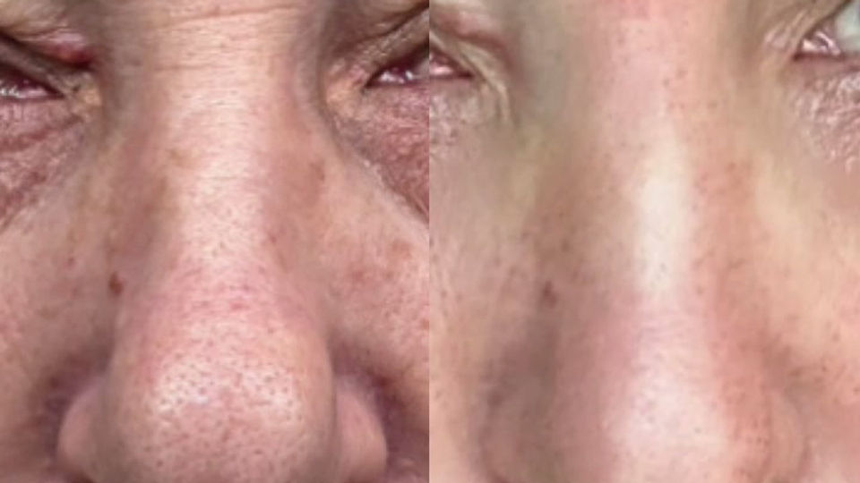 Preoblikovanje nosa plazma fibroblastima